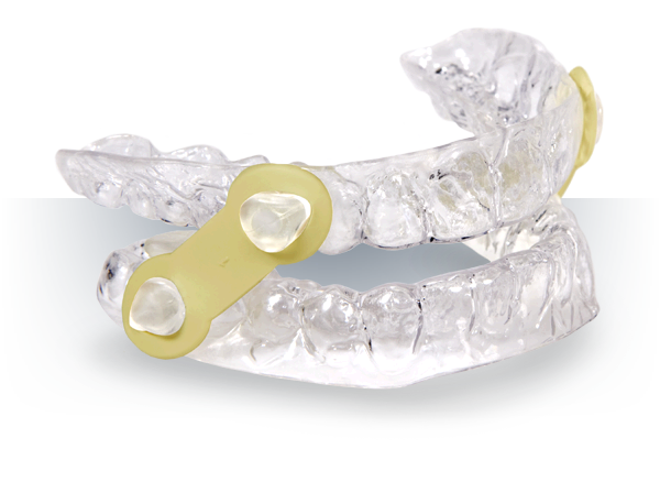 EMA Elastic Mandibular Advancement Appliance