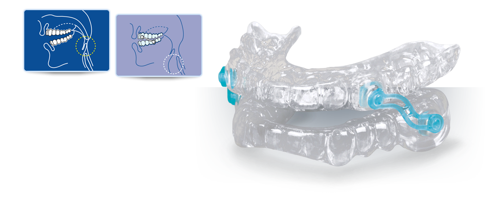 Silent Nite Slide-Link Snoring Prevention Device